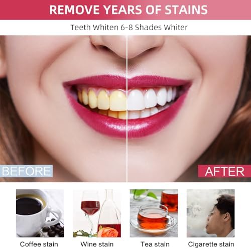 Professional Teeth Whitening Kit with 5 Teeth Whitening Gel, LED Accelerator Light & Rechargeable Design - Enamel Safe Gel, Custom Trays, Fast Results for Sensitive Teeth - Whitening Gel Kit